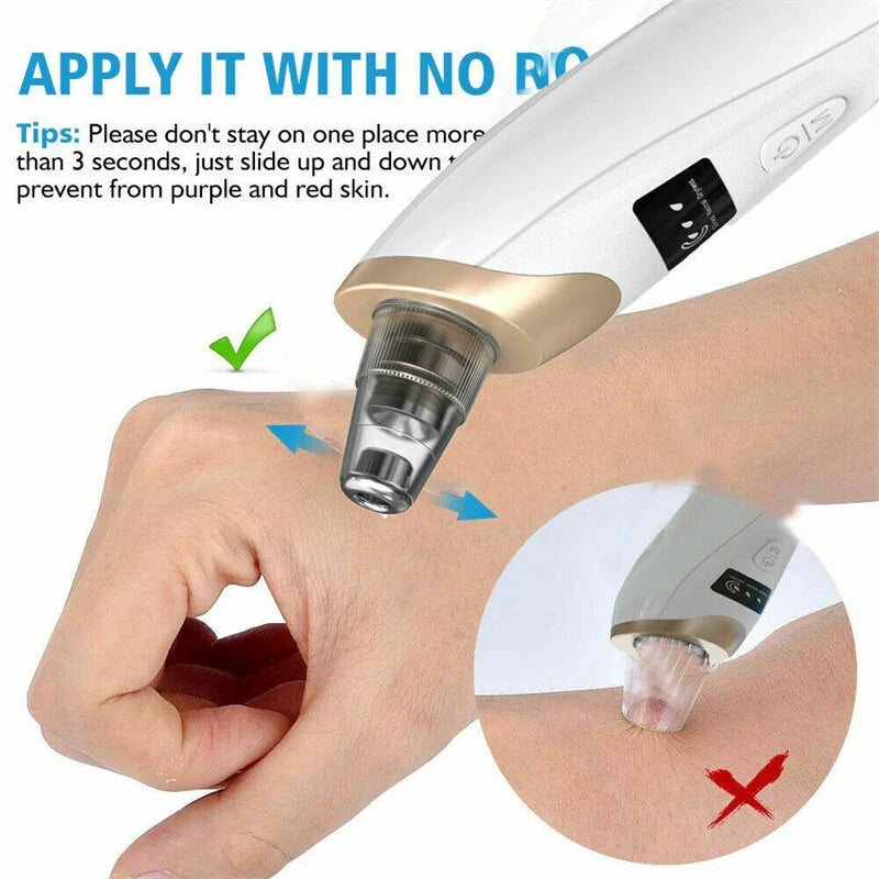 5 in 1 Blackhead Remover Skin Care Pore Vacuum .