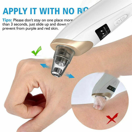 5 in 1 Blackhead Remover Skin Care Pore Vacuum  .